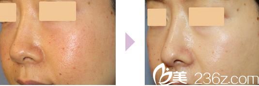 鼻中隔延長(zhǎng)術(shù) 鼻中隔延長(zhǎng)術(shù)