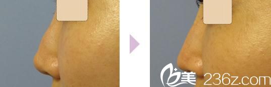 駝峰鼻修正 駝峰鼻修正