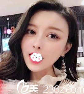 朋友在割雙眼皮效果挺好,讓我找陳茂年做硅膠假體隆鼻綜合整形