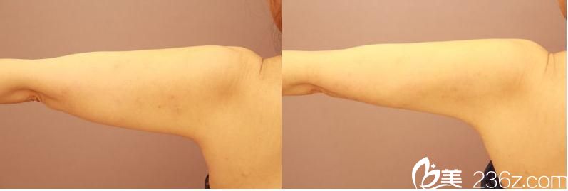 ベイザ吸脂 ベイザ吸脂