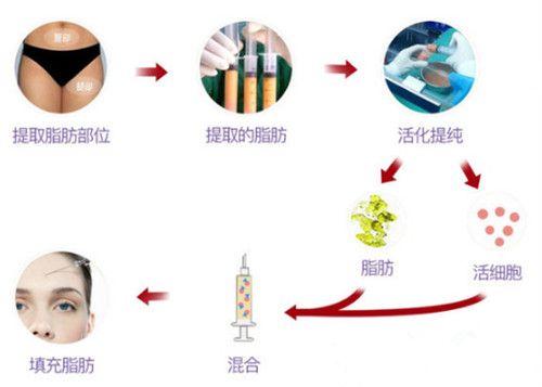 美立方(大華)整形醫(yī)院采用純自體脂肪填充術(shù)