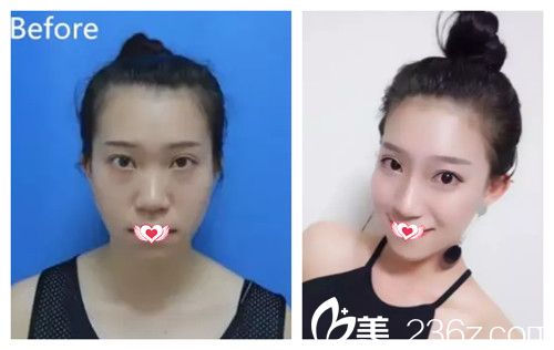 張家口維多利亞注射玻尿酸案例 張家口維多利亞注射玻尿酸案例