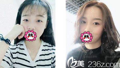 泰州麗都整形雙眼皮案例 泰州麗都整形雙眼皮案例