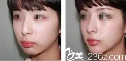 泰州麗都整形隆鼻案例 泰州麗都整形隆鼻案例