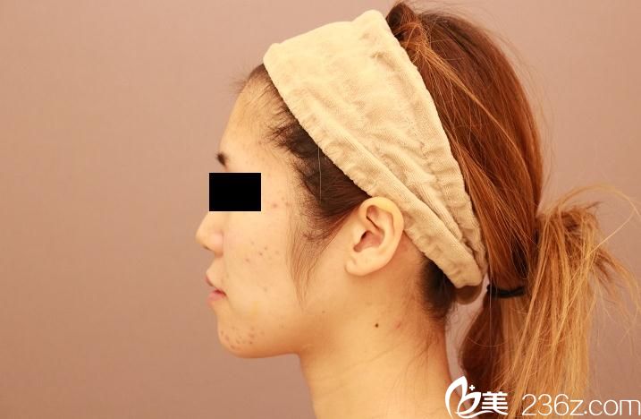 臉部脂肪填充前