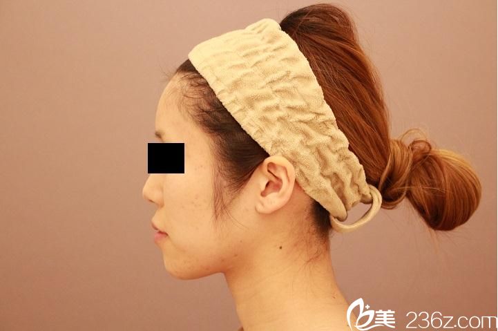 臉部脂肪填充后