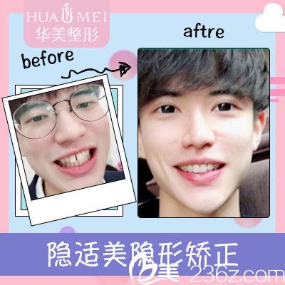 汕頭華美王宏偉醫(yī)生做的隱適美牙齒矯正案例