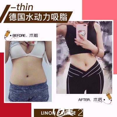 汕頭華美楊善醫(yī)生做的腰腹吸脂案例