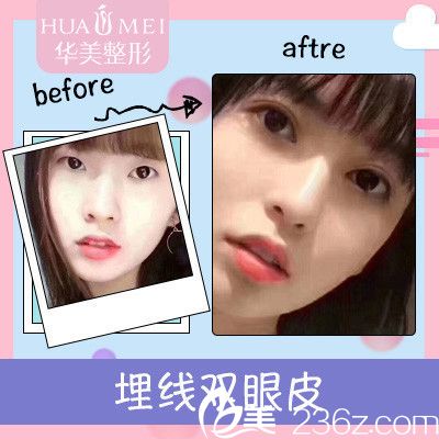 汕頭華美蔣友寧院長(zhǎng)做的雙眼皮案例