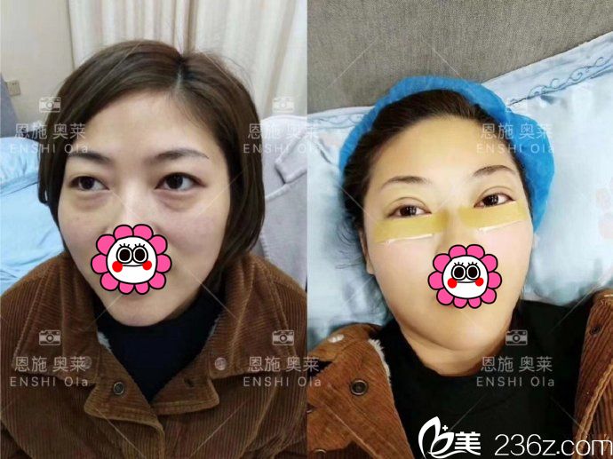 李登進(jìn)雙眼皮案例