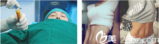 成都easy SCULPT怡脂醫(yī)療美容整形醫(yī)院LAMS吸脂