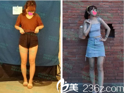 成都easy SCULPT怡脂醫(yī)療美容整形醫(yī)院大腿吸脂案例