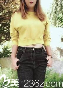 聽說昆明美伊萊和韓辰吸脂都挺好，讓覃愛祥院長(zhǎng)做水動(dòng)力腰腹吸脂三個(gè)月案例圖片