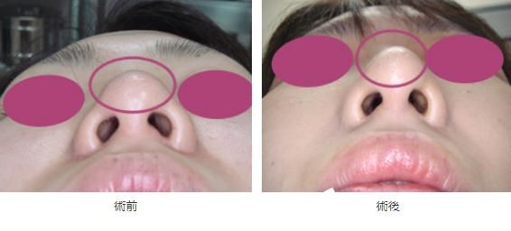 隆鼻術(shù) 隆鼻術(shù)