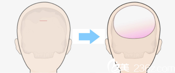 韓國ITEM（愛婷）整形醫(yī)院后腦勺整形示意圖