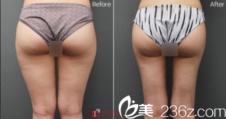 韓國ITEM（愛婷）整形醫(yī)院腿部吸脂案例