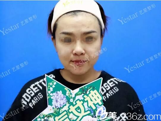 臉上痘痘痘印明顯 臉上痘痘痘印明顯