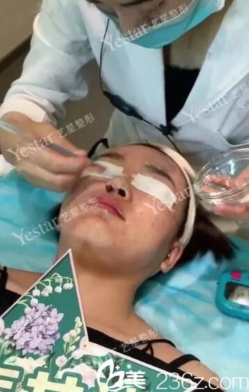 果酸換膚祛痘治療中 果酸換膚祛痘治療中