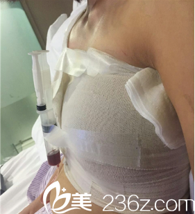 董琪主任給我手術(shù)完第三天