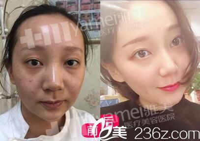 在雅美做黃金軟微針術(shù)前術(shù)后對(duì)比 在雅美做黃金軟微針術(shù)前術(shù)后對(duì)比