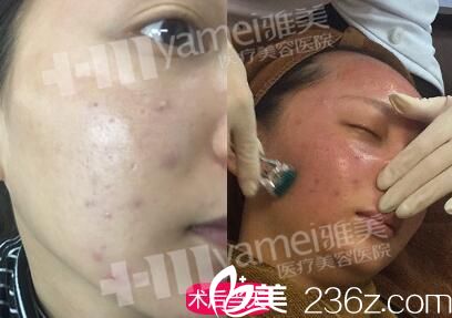 做黃金軟微針術(shù)過(guò)程中 做黃金軟微針術(shù)過(guò)程中
