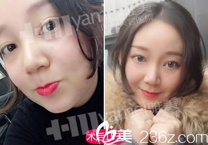 做黃金軟微針術(shù)后15天效果 做黃金軟微針術(shù)后15天效果