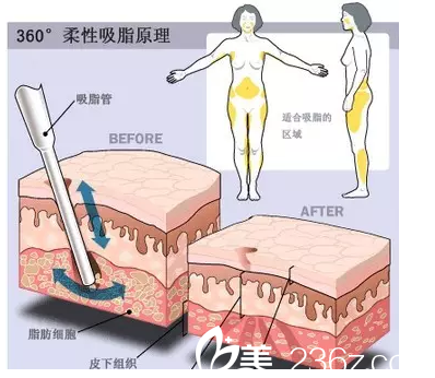 北京玲瓏梵宮水動(dòng)力吸脂特惠價(jià)格來(lái)襲！首部位666元，名醫(yī)王光輝坐診