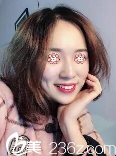 遵義韓美下頜角加顴骨內(nèi)推術(shù)后一個月