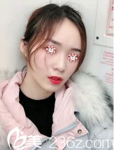 董琪下頜角整形術(shù)后13天