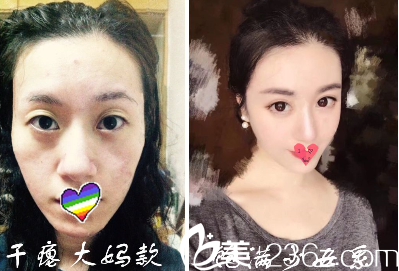 貴陽美貝爾自體脂肪全臉填充案例