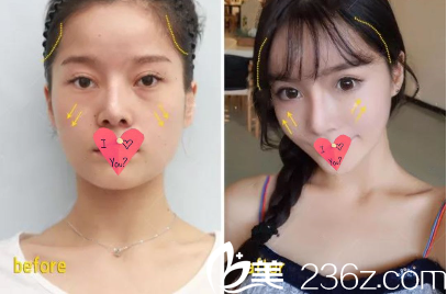 貴陽美貝爾朱曉東做自體脂肪面部填充怎么樣