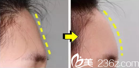 貴陽美貝爾自體脂肪填充額頭案例效果