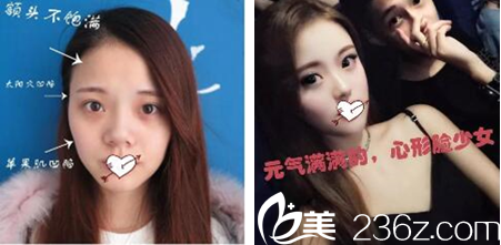 貴陽美貝爾自體脂肪填充案例