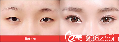 眼部整形前后對(duì)比效果