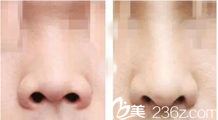 鼻部整形前后對(duì)比效果