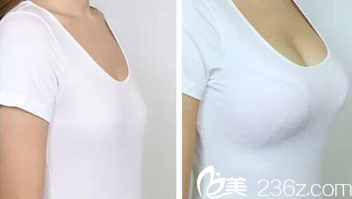 胸部整形前后對(duì)比效果