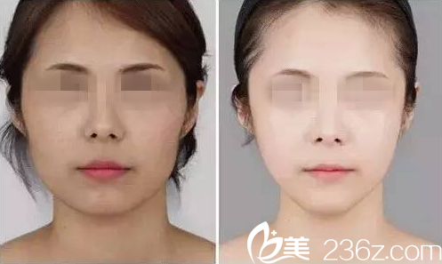 微整形前后對(duì)比效果