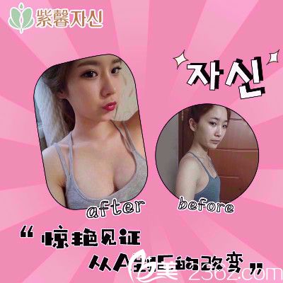 廣州紫馨整形醫(yī)院假體隆胸案例 廣州紫馨整形醫(yī)院假體隆胸案例