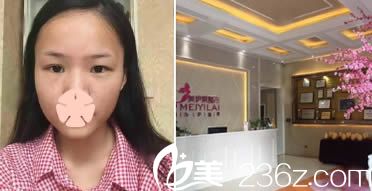 昆明美伊萊整形面部填充術(shù)前照 昆明美伊萊整形面部填充術(shù)前照