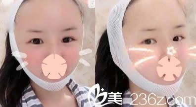 昆明美伊萊醫(yī)療美容自體脂肪面部填充天照 昆明美伊萊醫(yī)療美容自體脂肪面部填充天照