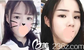 昆明美伊萊整形面部脂肪填充術(shù)后7天照 昆明美伊萊整形面部脂肪填充術(shù)后7天照