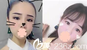 做了昆明美伊萊整形周誠(chéng)院長(zhǎng)擅長(zhǎng)的自體脂肪面部填充后使我逆變童顏臉