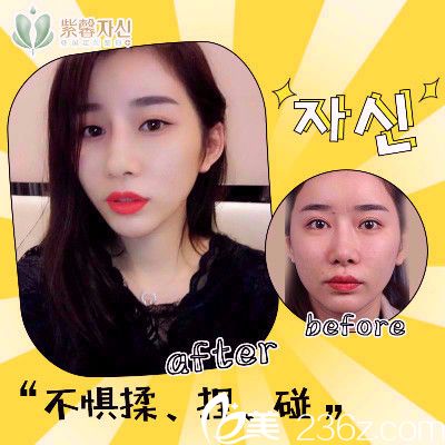 廣州紫馨金孝憲做的隆鼻子案例圖 廣州紫馨金孝憲做的隆鼻子案例圖