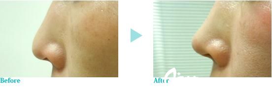 鼻中隔延長(zhǎng)術(shù)