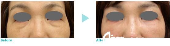 去眼袋手術(shù)