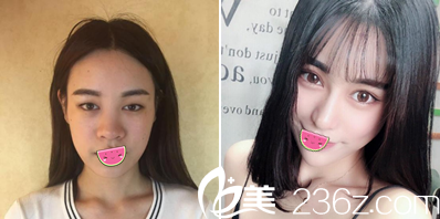 眼綜合+鼻綜合術(shù)后效果