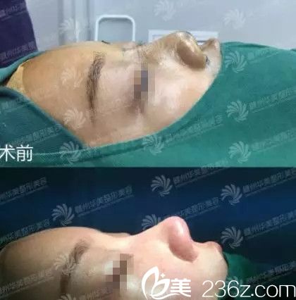 贛州華美整形醫(yī)院鼻修復(fù)手術(shù)對(duì)比效果
