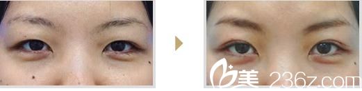 部分切開(kāi)法 部分切開(kāi)法