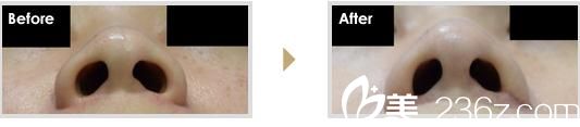 小鼻縮小法 小鼻縮小法
