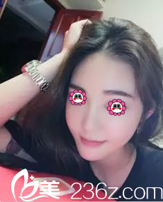 沖北京麥西美嘉醫(yī)院好口碑和價(jià)格優(yōu)惠我做了硅膠假體隆鼻